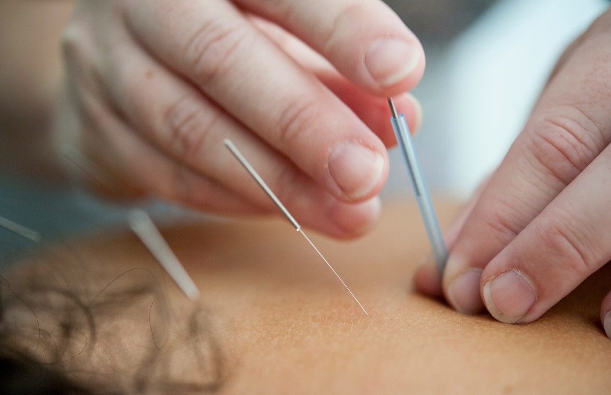 Hormonal balance acupuncture treatment